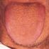 Signifcado de saburra seca de la lengua en MTC